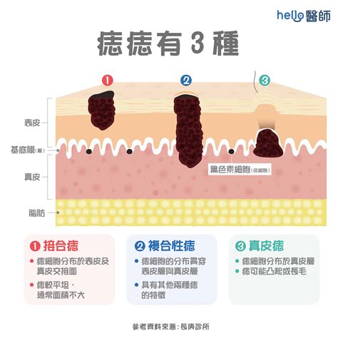 痣是如何形成的|痣形成的原因？痣長毛、痣變多變大是痣病變？5招判。